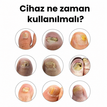 Calvens™ - Tırnak Bakım Cihazı
